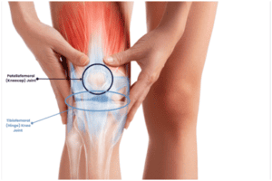 Patellofemoral 300x200 - Physiotherapy Approaches for Effective Patellofemoral Pain Treatment