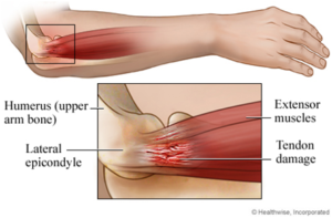 tennis elbow 300x197 - Recognizing the Signs: Symptoms of Tennis Elbow